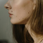 woman with skin lesion