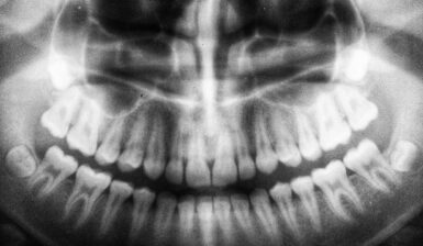 xray of teeth