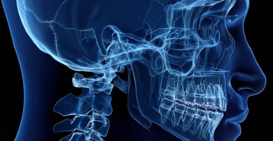 x-ray of teeth and jaw